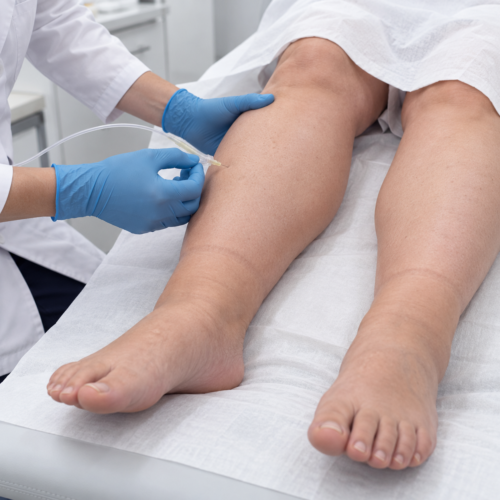 CARBOSSITERAPIA PER RITENZIONE IDRICA E PESANTEZZA ALLE GAMBE : 12 Sedute