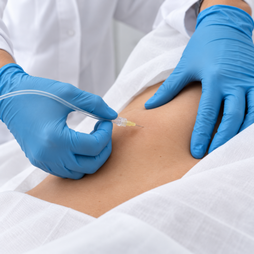 CARBOSSITERAPIA PER RIDURRE ADIPE E CELLULITE : Una seduta