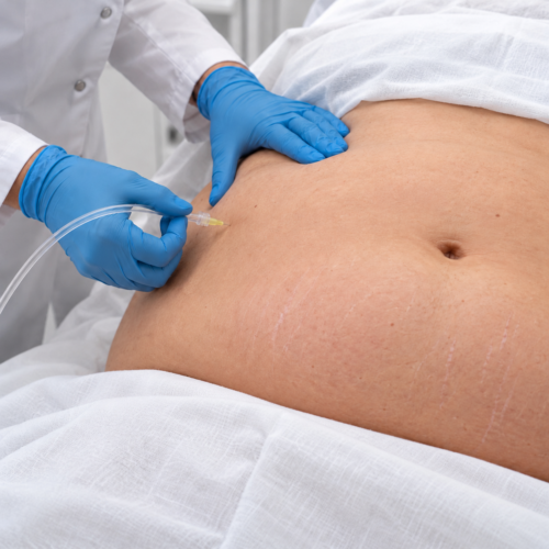 CARBOSSITERAPIA PER RIDURRE ADIPE E CELLULITE : 10 Sedute