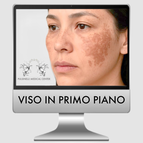 TRATTAMENTO DEL MELASMA CON LASER FRAXEL VISO COMPLETO