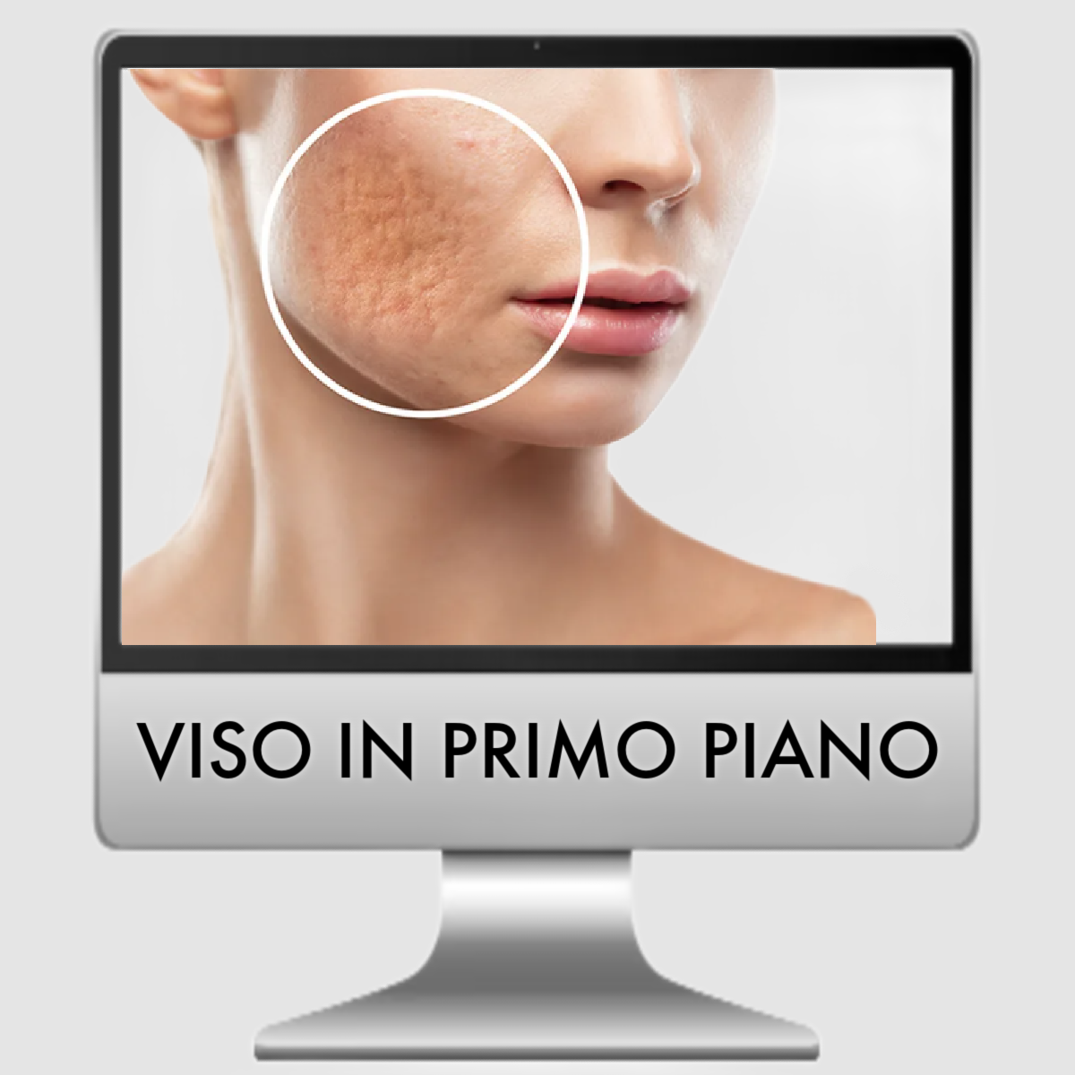 LASER FRAXEL TRATTAMENTO CICATRICI VISO PARZIALE