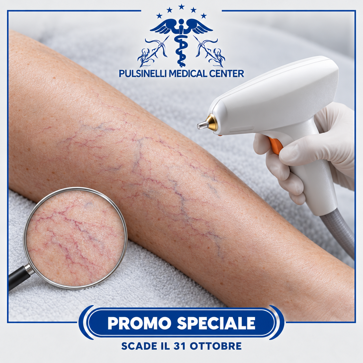 TRATTAMENTO LASER RIMOZIONE CAPILLARI GAMBE