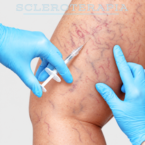 SCLEROTERAPIA PER CAPILLARI E VENE RETICOLARI-GAMBE